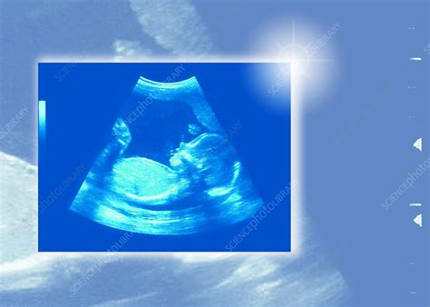 20-week baby scan - Stock Image - F005/6185 - Science Photo Library