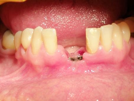 Inadequate Bone Volume Case Recommendations