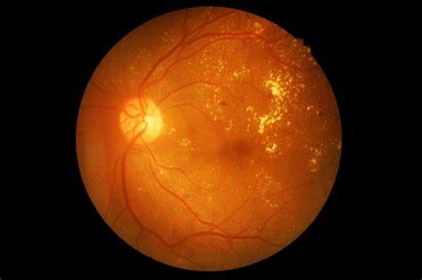 Fda Approves Ai Device To Detect Diabetic Retinopathy Medical Bag