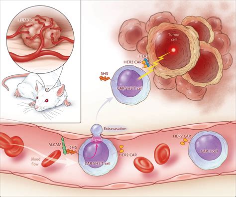 引导car T细胞进入实体瘤 Nejm医学前沿