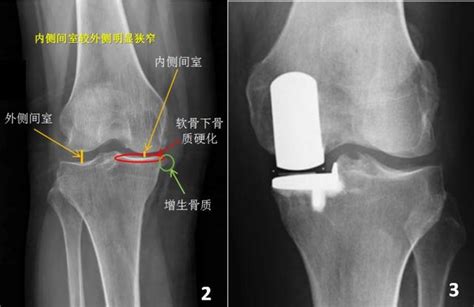 微創手術治療膝關節骨關節炎 每日頭條