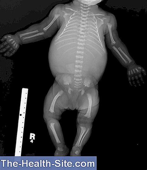 Achondroplasia Causes Symptoms Treatment 💊 Scientific Practical