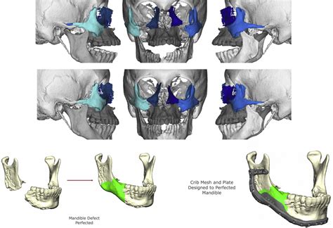 Three-Dimensional Computer-Assisted Surgical Planning, Manufacturing
