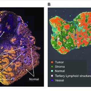 Microphotographs Of A Representative Section Of Lung Squamous Cell