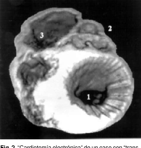 Figure 1 From La Ecocardiografía Tridimensional En El Diagnóstico De