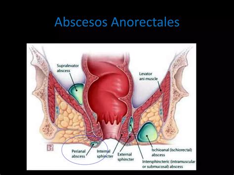 Abscesos Y F Stulas Perianales Ppt