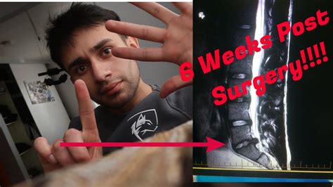 Microdiscectomy 6 Months Post Surgery Advice L5s1 Youtube