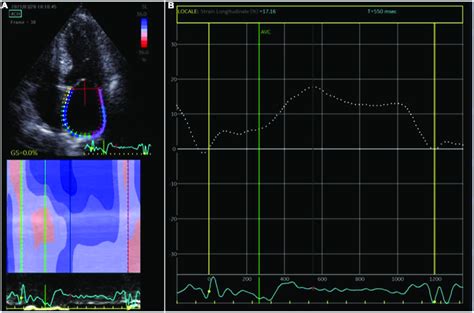 Atrial Strain Measurement A The Apical Four Chamber View Was