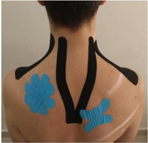 Application Of Kinesio Tape Kt Download Scientific Diagram