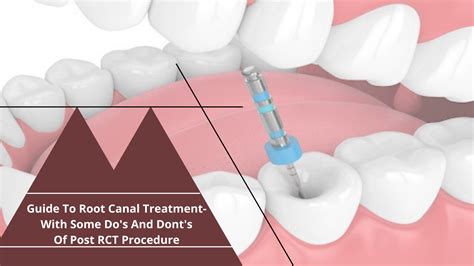 Guide To Root Canal Treatment With Some Dos And Donts Of Post Rct