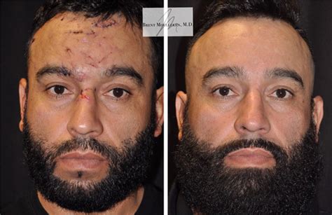 Reconstructive Surgery Before and After Photos Before and After Photos ...