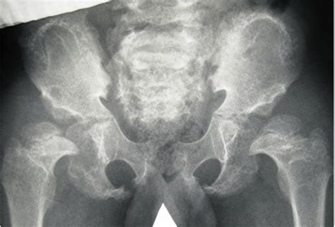 Anteroposterior Pelvis Radiograph Showed A Dysplastic Pelvis The Iliac