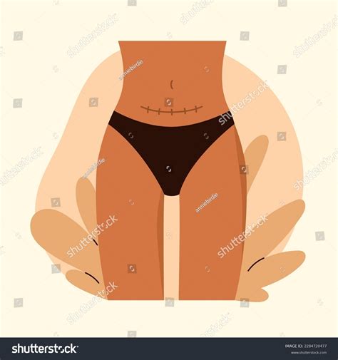 Cesarean Scar Stitches After Caesarean Section Stock Vector Royalty