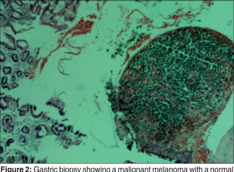 Digestive System Melanoma | Semantic Scholar