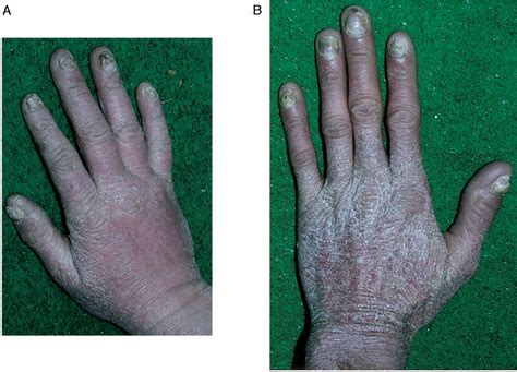 Figure 2 From An Immune Defect Causing Dominant Chronic Mucocutaneous