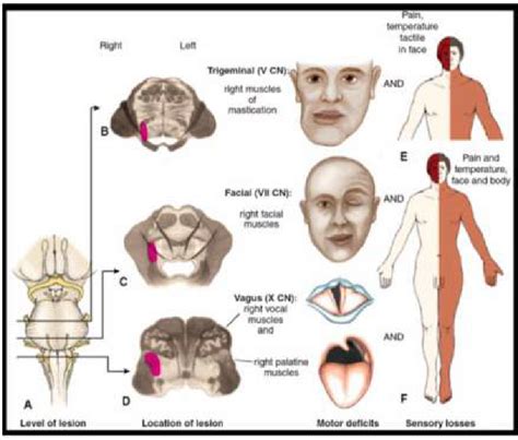 Transverse Section Of The Midbrain Neet Pg Anatomy