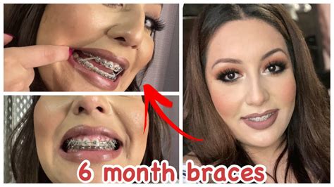 6 Month Braces Update Overjet Overbite Damon Braces Adult Braces