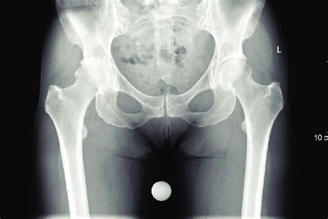 Standard AP Pelvic Radiograph Showing A Patient With Signifi Cant