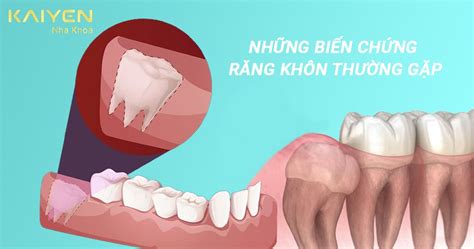 Những biến chứng răng khôn thường gặp và cách xử lý Nha khoa Quốc Tế