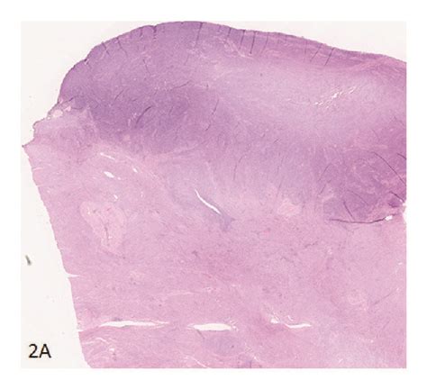 Microscopic Aspects Of Lymphoepithelioma Like Carcinoma At Low Power