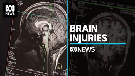 Ex-Rugby player says concussion injuries are 'a ticking time bomb ...