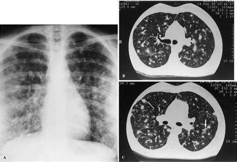 Hypersensitivity Pneumonitis Producing A Boop Like Reaction Journal Of Thoracic Imaging