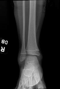 OrthoDx: Suspected Pediatric Ankle Fracture - Clinical Advisor