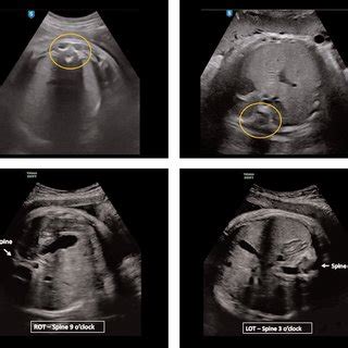 Transabdominal ultrasound imaging in the transverse plane for locating ...