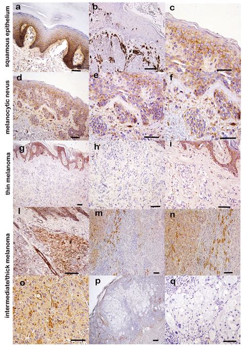 CD9 Expression In Melanocytic Nevi And Melanomas A C CD9 Staining In