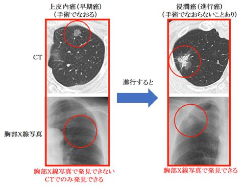 低線量ctによる肺がん検診のご案内 独立行政法人国立病院機構 山口宇部医療センター