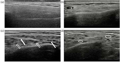 Ultrasound Guided Core Needle Biopsy Cnb Of The Major Salivary Glands Download Scientific