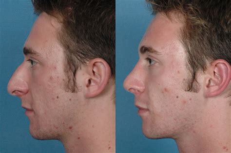 Non Surgical Rhinoplasty Il Injectable Rhinoplasty Champaign