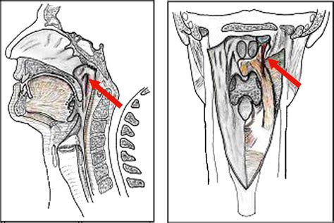 The salpingopharyngeus muscle is identified by the arrow. | Download ...