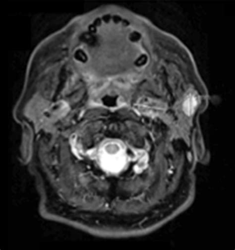 Multiple Synchronous Unilateral Parotid Adenomas A Case Series