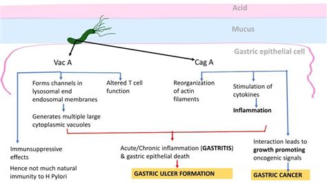 H Pylori Gastritis Pathology Made Simple