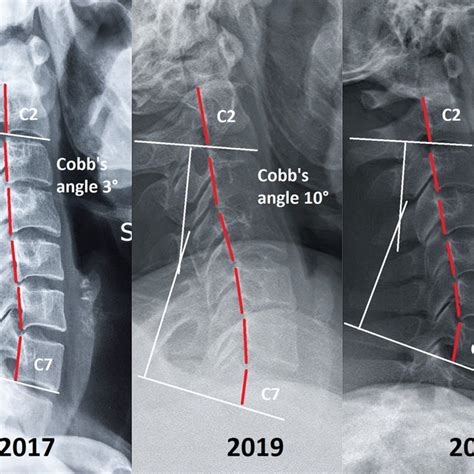 Sagittal Cervical Radiographs 2017 Initial Radiograph Showed