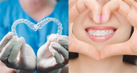 Invisalign Or Braces Zara Dental Houston