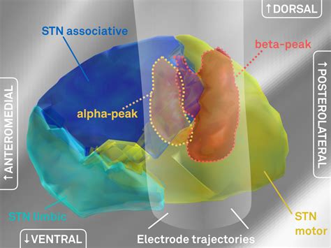 Subcortical Electrophysiology Mapping Lead DBS