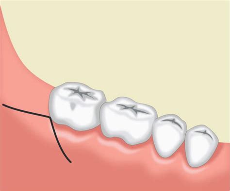 Flap Techniques In Dentoalveolar Surgery Intechopen