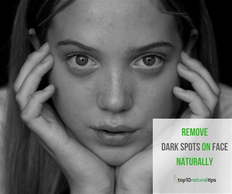 Top 10 Home Remedies To Get Rid Of Dark Spots On Face Top10 Natural Tips