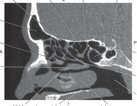 Sagittal Ct Nasal Meatus Sinus Diagram Quizlet