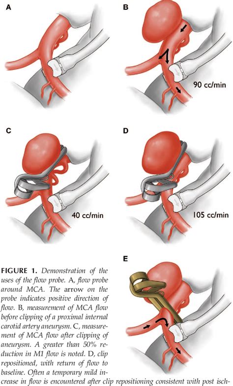 Figure 1 From The Utility Of Intraoperative Blood Flow Measurement