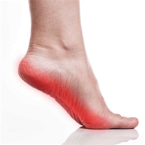 Plantar Fasciitis | Physio Fixes
