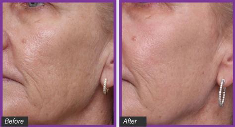 UltraClear Laser Treatment My Face Surgeon