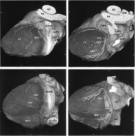 Persistent Left Superior Vena Cava Demonstrated With Multislice Spiral