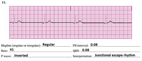 Ecg Chapter Heart Block Dysrhythmias Flashcards Quizlet