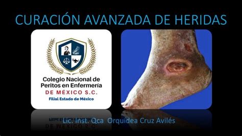 CURACIÓN AVANZADA DE HERIDAS pdf