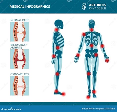 Rheumatism Or Rheumatic Disorder Medical Posters Arthritis Joint Pain