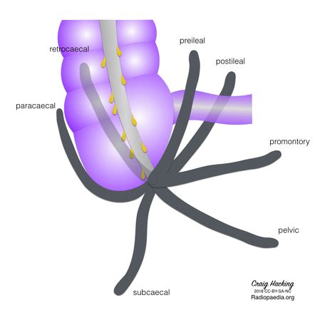 Acute appendicitis | Radiology Reference Article | Radiopaedia.org