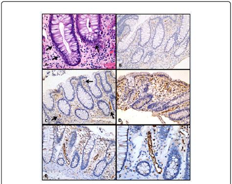 Colonic Biopsy From Patients With Clinical Features Of Gvhd A Hande Download Scientific Diagram